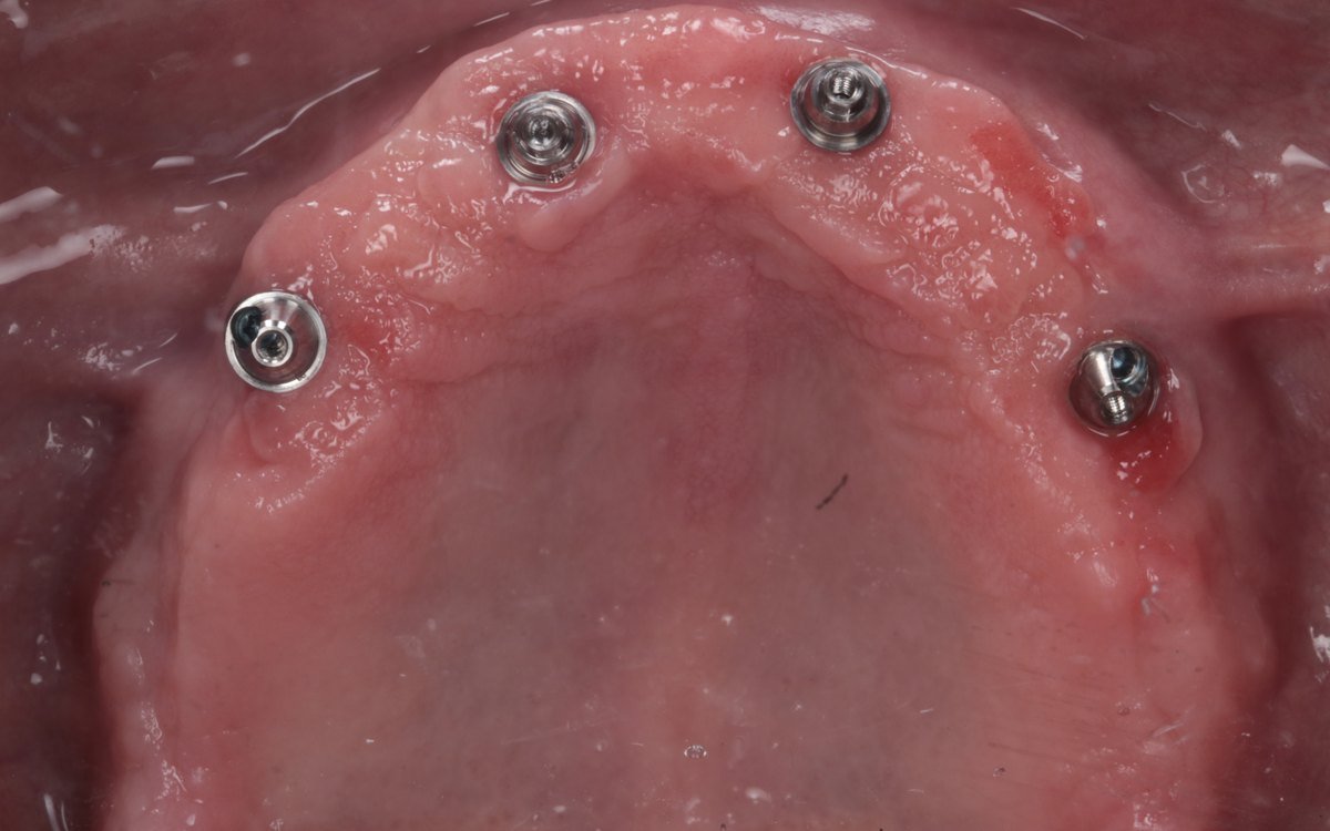 Implantes y pilares colocados: Rehabilitación full arch con implantes dentales