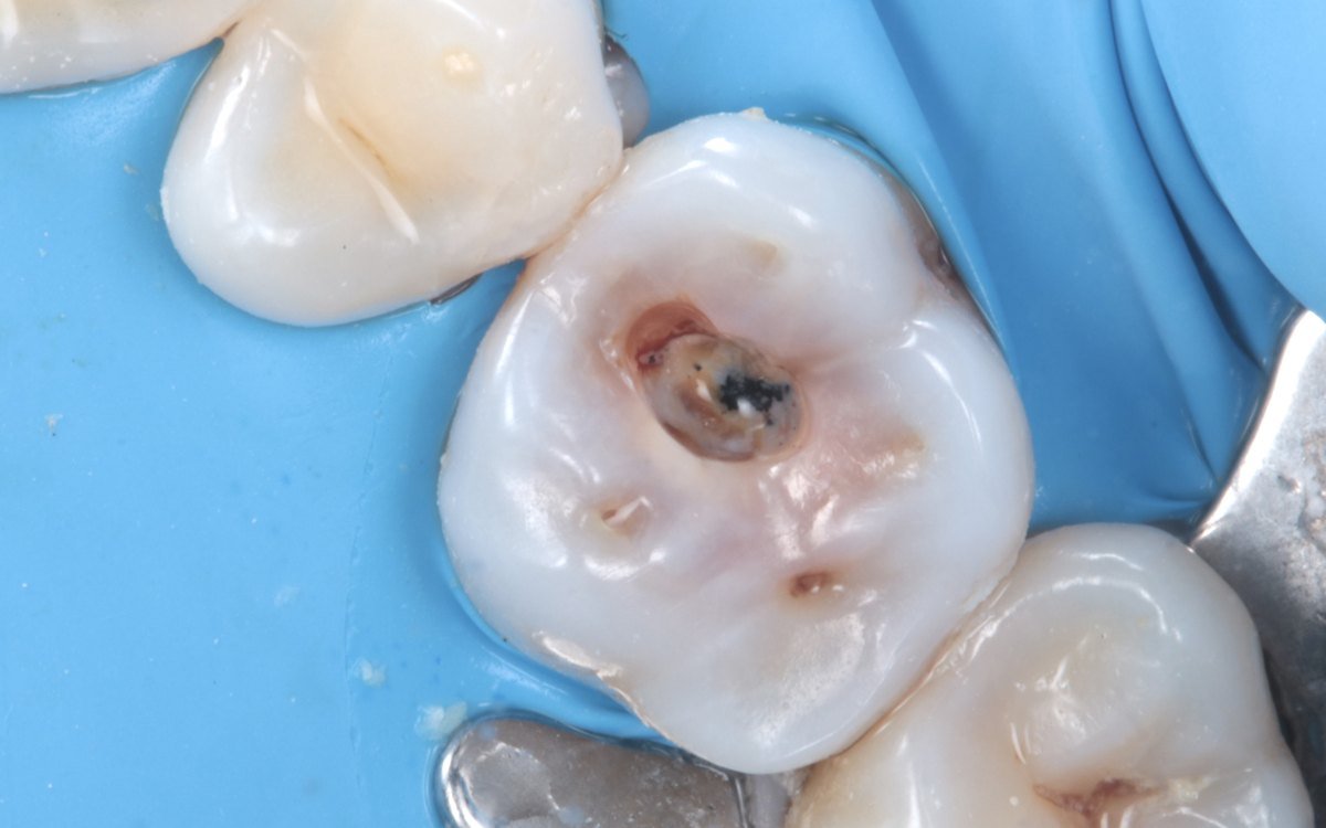 La caries, antes de removerla: Restauración de un molar con resina compuesta